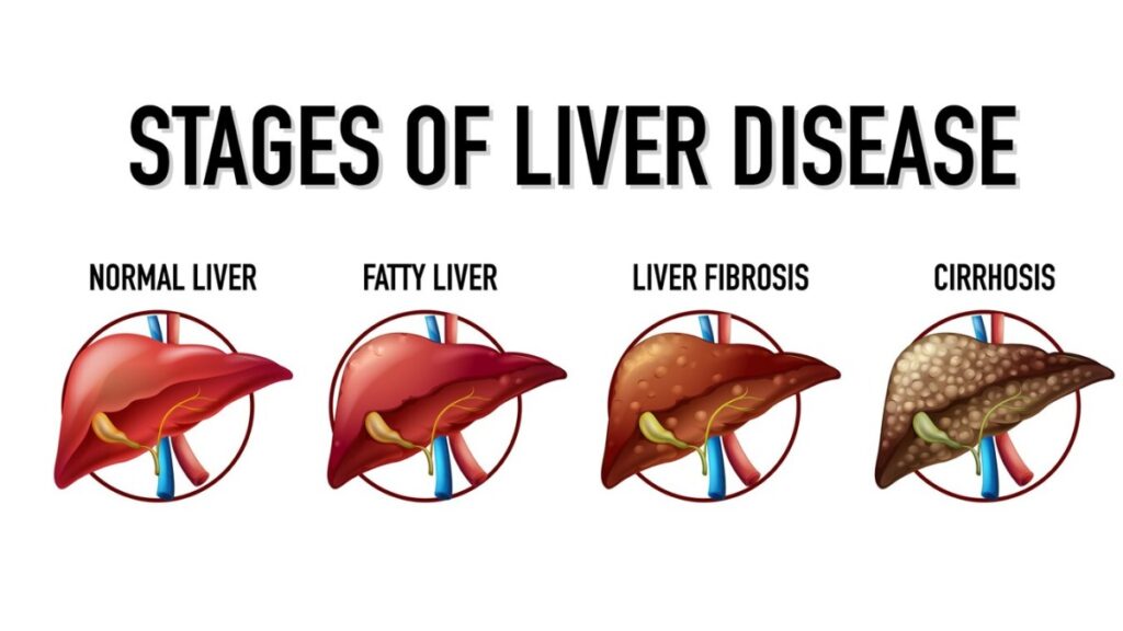 लिवर सिरोसिस क्या है